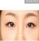 韩国伊美芝去眼袋和黑眼圈手术案例