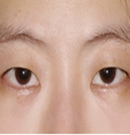 韩国MVP整形医院双眼皮手术对比图
