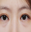 韩国MVP整形医院双眼皮手术对比图