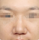 韩国MVP整形医院蒜头鼻矫正手术案例对比术后