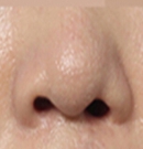 韩国MVP整形医院唇腭裂第二次鼻部再建整形术对比案例