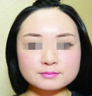 韩国那木下颌角手术，让我拥有小v脸