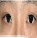 韩国主恩整形医院双眼皮修复对比照片