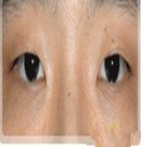 韩国主恩整形医院双眼皮修复对比照片