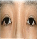 韩国主恩整形医院双眼皮变单眼皮对比照