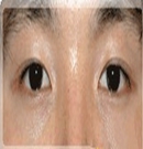 韩国主恩整形医院双眼皮变单眼皮对比照