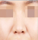 韩国友珍整形瘦脸除皱除皱对比图