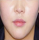 韩国友珍整形瘦脸除皱瘦脸对比图术后