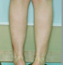 韩国友珍整形小腿缩小术对比图