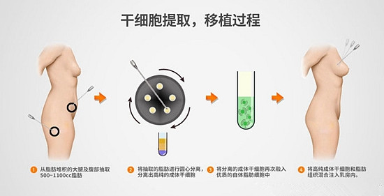 韩国sc301整形外科隆胸