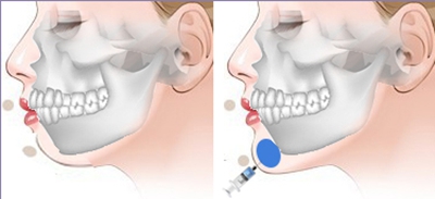 注射丰下巴