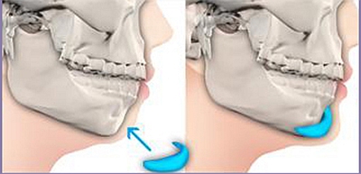 假体植入丰下巴