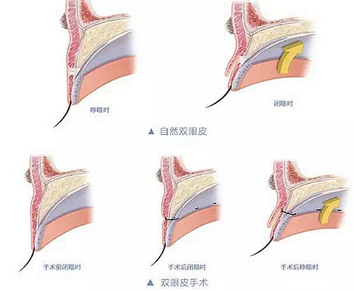 双眼皮手术