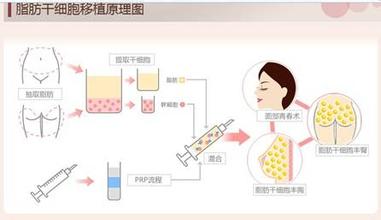 重庆星范丽格自体脂肪移植