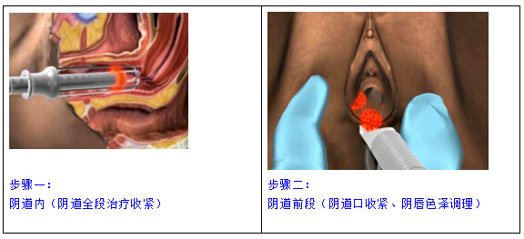 福州海峡阴道紧缩