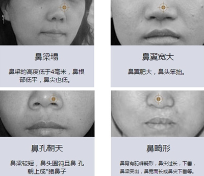 重庆五洲隆鼻手术怎么样价格是多少