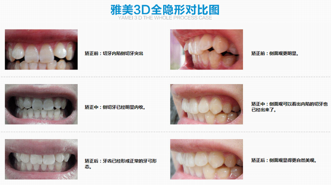 雅美3D全隐形矫正  无痕矫正牙齿