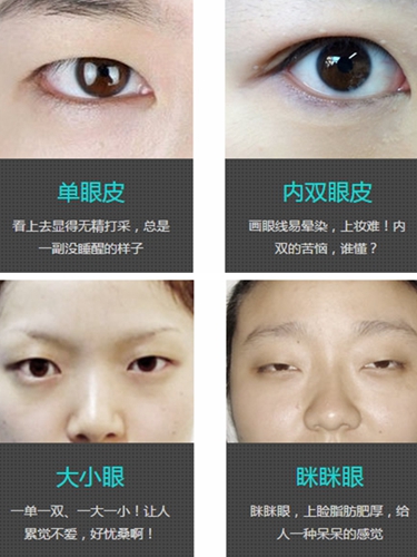 武汉伊美尚双眼皮手术有什么优势