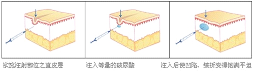 玻尿酸注射除皱原理