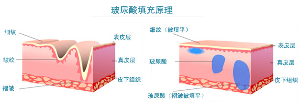 长沙爱思特乔雅登玻尿酸