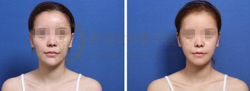 韩国女神整形医院下巴整形、颧骨缩小术案例