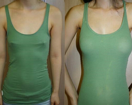乳房悬吊术前后图片