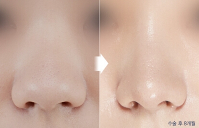 重庆曼格整形NAB鼻整形手术对比案例