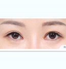 韩国DA整形医院双眼皮修复案例