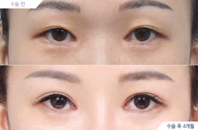 韩国DA整形医院双眼皮修复案例