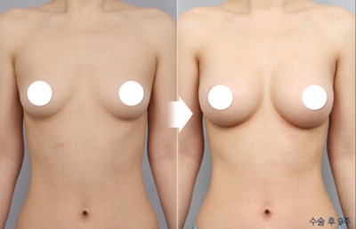 韩国DA整形医院胸部整形案例