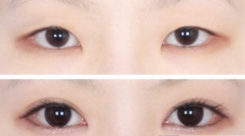 韩式双眼皮案例