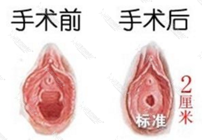 韩国好手艺妇科医院处女膜修复手术