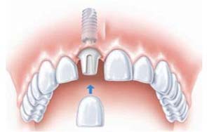 合肥贝杰口腔单颗牙种植缺牙修复