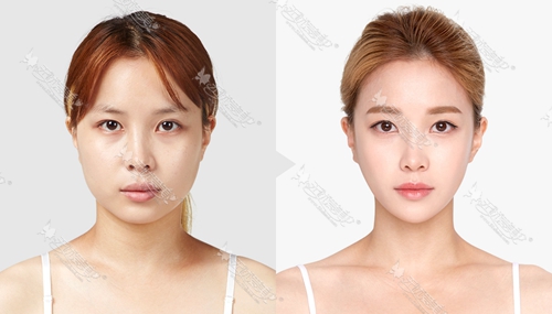 韩国TL整形医院高级v脸轮廓对比案例