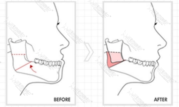 下巴线条调整截骨术