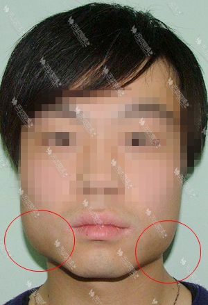 男士下颌角整形北京哪家医院好呢