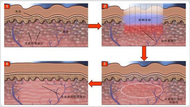 韩国首尔丽格射频紧肤过程