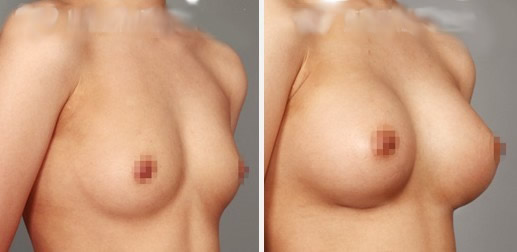 温岭整形隆胸手术案例展示