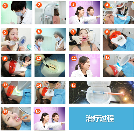 韩国Newface牙齿美白治疗过程