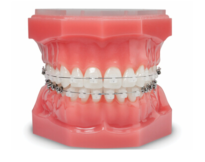 韩国Newface牙齿矫正陶瓷自锁托槽模型