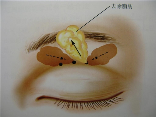 成都天之美韩式双眼皮手术操作
