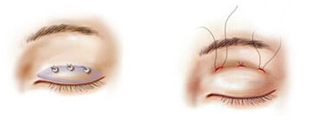 成都爵丽韩式双眼皮手术方法