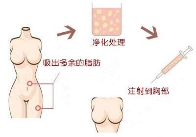 重庆自体脂肪隆胸哪家医院好 