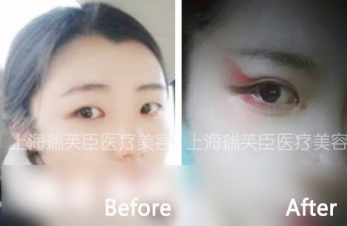 上海瑞芙臣双眼手术案例
