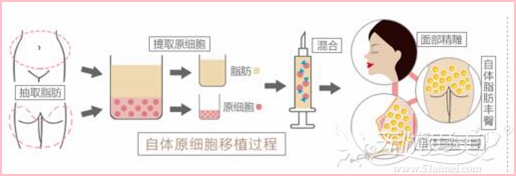 赣州华美自体脂肪移植面部填充