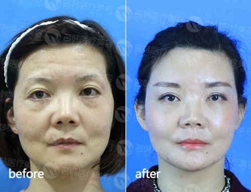 李阳医生操作韩国PRF自体脂肪移植综合整形手术案例展示