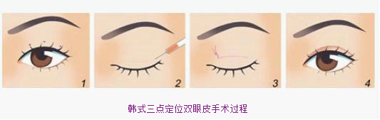 福州华美韩式三点法双眼皮手术操作