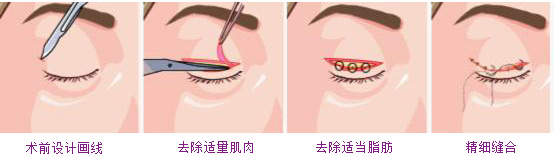福州华美韩式埋线法双眼皮手术操作