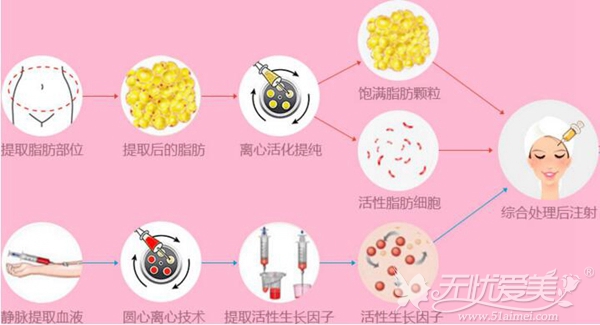 自体脂肪面部除皱过程