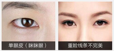 烟台壹美整形韩式双眼皮改善单眼皮眯眯眼